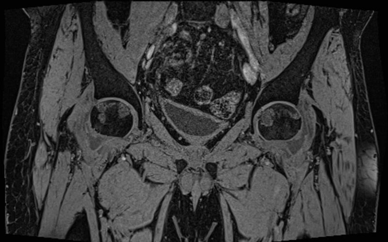 File:Bilateral avascular necrosis of femoral head (Radiopaedia 77116-89078 Coronal T2 we 55).jpg