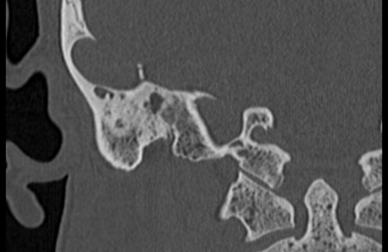 File:Bilateral cholesteatoma (Radiopaedia 54898-61172 Coronal bone window 72).jpg