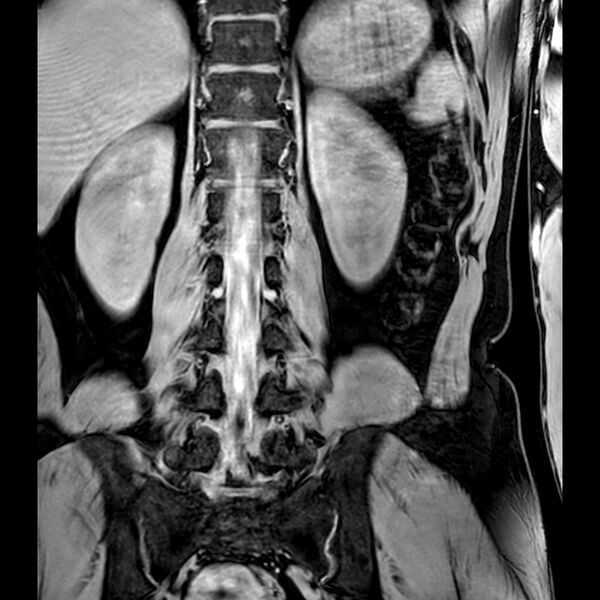 File:Bilateral conjoined nerve roots at different levels (Radiopaedia 73312-84063 B 30).jpg