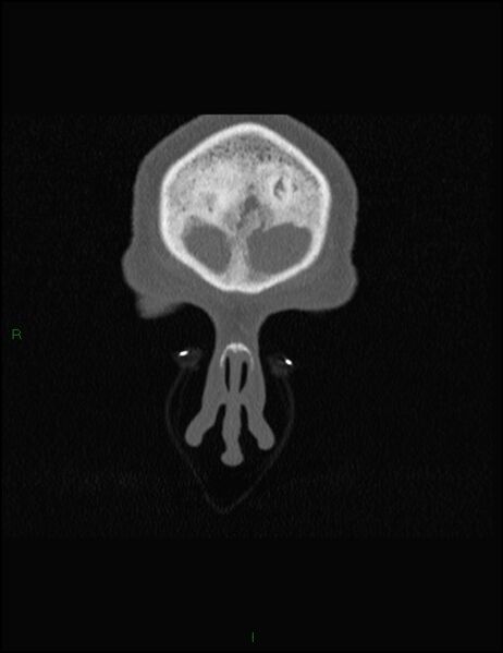 File:Bilateral frontal mucoceles (Radiopaedia 82352-96454 Coronal 36).jpg