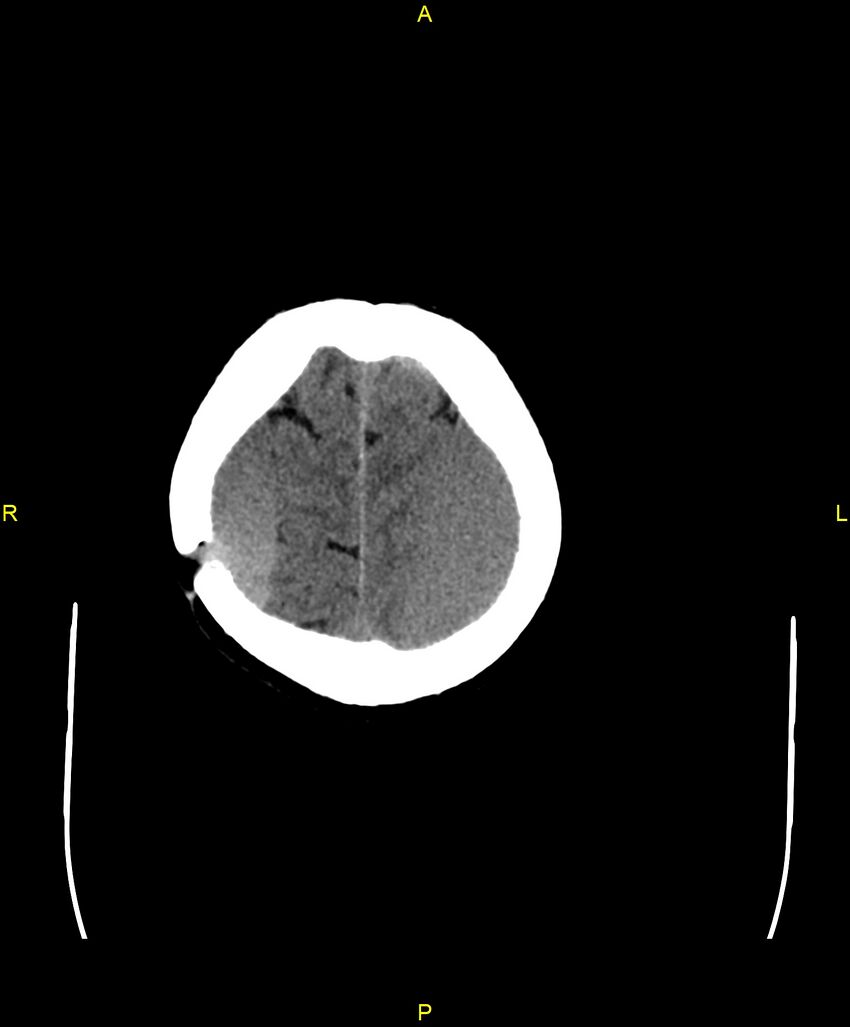 Bilateral isodense subdural hematomas (Radiopaedia 88621-105325 Axial non-contrast 96).jpg
