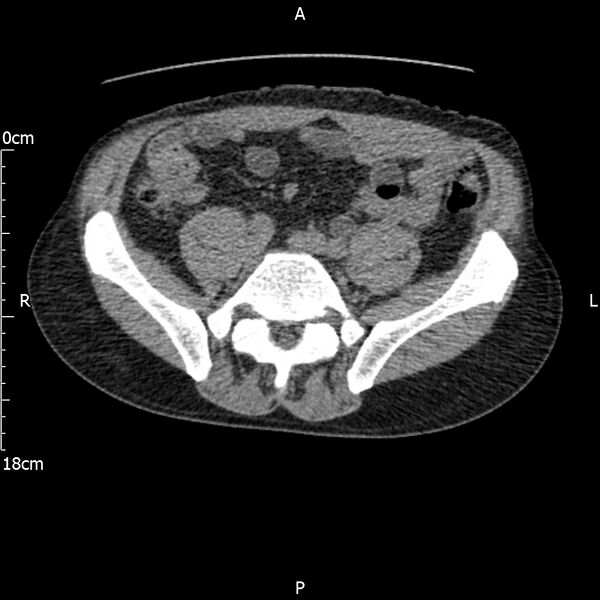 File:Bilateral medullary nephrocalcinosis with ureteric calculi (Radiopaedia 71269-81569 Axial non-contrast 90).jpg