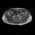 Bilateral ovarian fibroma (Radiopaedia 44568-48293 Axial T1 6).jpg