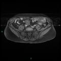 Bilateral ovarian fibroma (Radiopaedia 44568-48293 Axial T1 fat sat 3).jpg