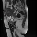 Bilateral ovarian fibroma (Radiopaedia 44568-48293 Sagittal T2 10).jpg