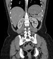Bilateral ovarian mature cystic teratomas (Radiopaedia 79373-92457 B 65).jpg