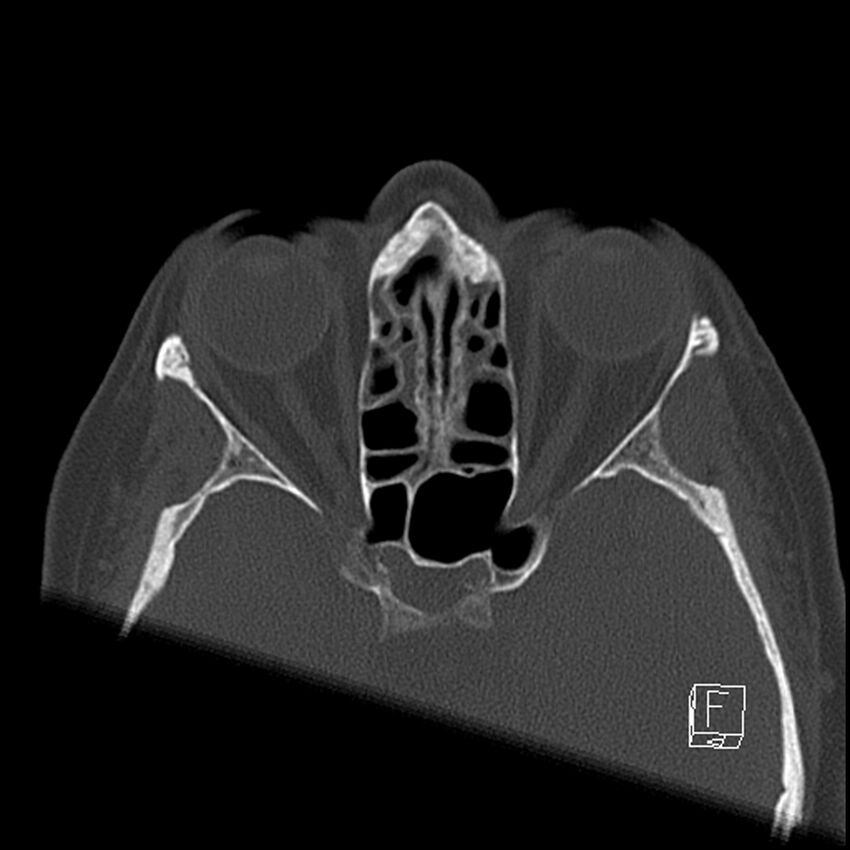 Bilateral palatine tonsilloliths on OPG and CT (Radiopaedia 75167-86247 Axial bone window 6).jpg