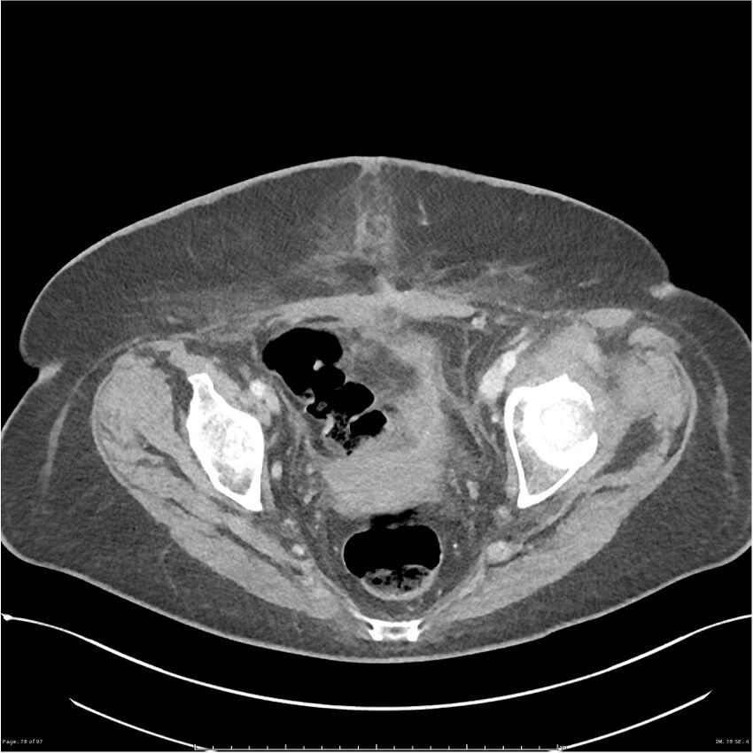 Bilateral psoas hematomas (Radiopaedia 24057-24279 A 78).jpg