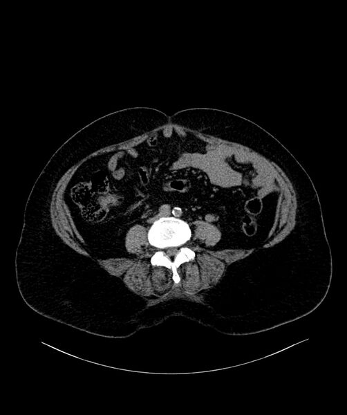File:Bilateral sporadic synchronous clear cell renal cell carcinoma (Radiopaedia 85035-100572 Axial non-contrast 45).jpg