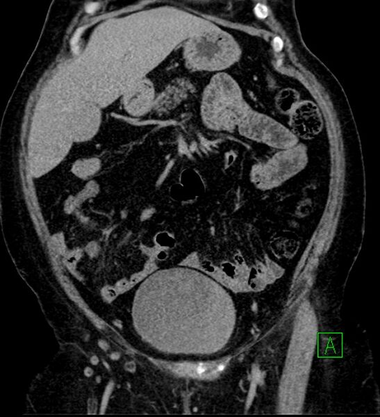 File:Bilateral sporadic synchronous clear cell renal cell carcinoma (Radiopaedia 85035-100575 I 11).jpg
