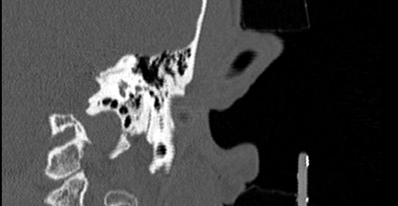 File:Bilateral temporal bone fractures (Radiopaedia 29482-29970 B 48).jpg