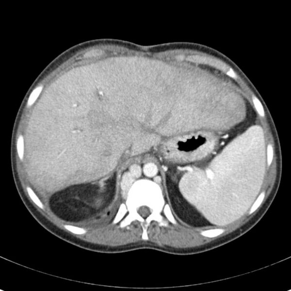 File:Biliary necrosis - liver transplant (Radiopaedia 21876-21846 B 14).jpg