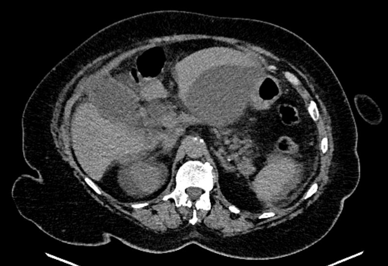 File:Biliary pancreatitis (Radiopaedia 72289-82823 Axial non-contrast 90).jpg