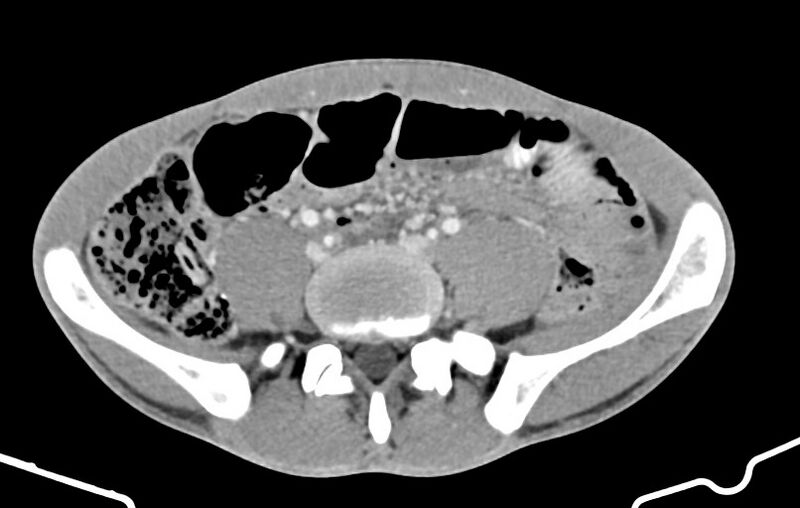 File:Blunt injury to the small bowel (Radiopaedia 74953-85987 A 127).jpg