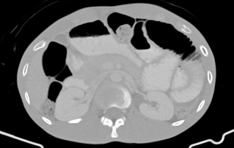 File:Blunt injury to the small bowel (Radiopaedia 74953-85987 Axial Wide 27).jpg