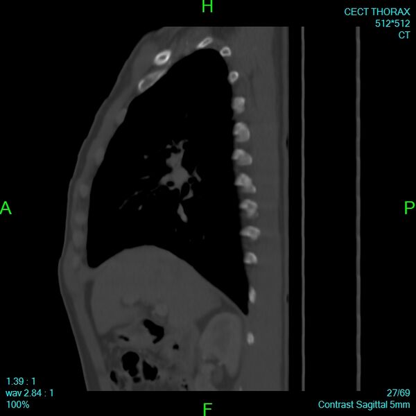 File:Bone metastases from lung carcinoma (Radiopaedia 54703-60937 Sagittal bone window 27).jpg