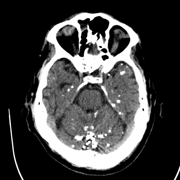 File:Brain Pantopaque remnants (Radiopaedia 78403-91048 Axial non-contrast 37).jpg