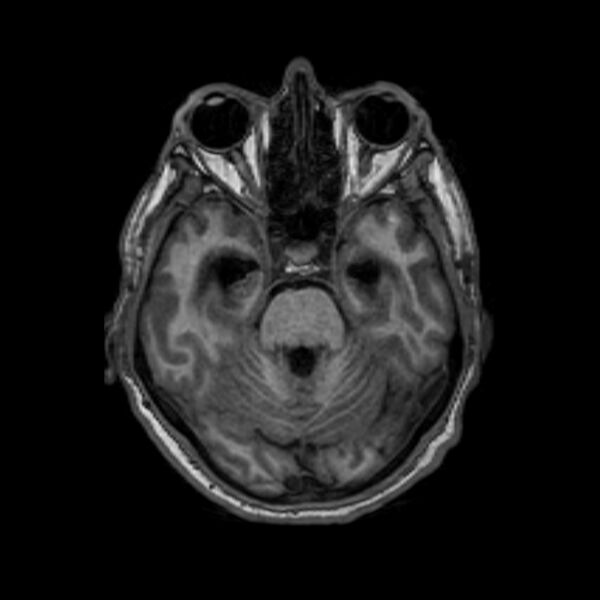 File:Brain abscess complicated by intraventricular rupture and ventriculitis (Radiopaedia 82434-96577 Axial T1 19).jpg