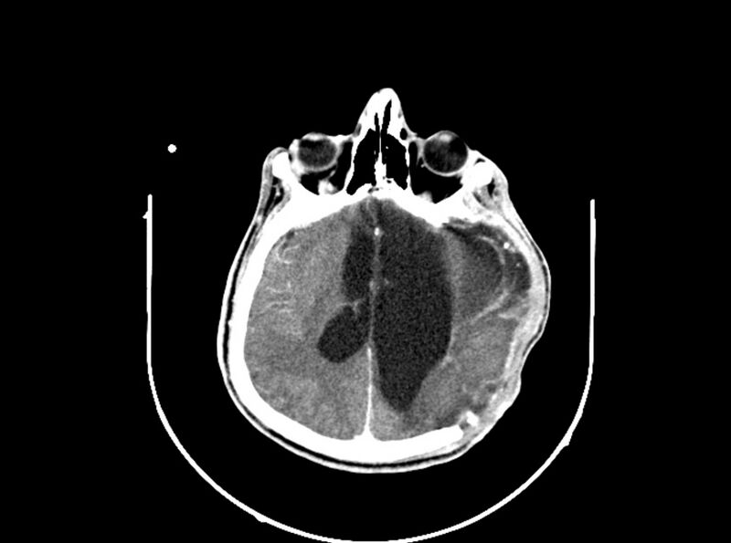 File:Brain injury by firearm projectile (Radiopaedia 82068-96088 B 134).jpg