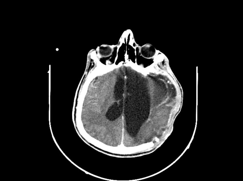 Brain injury by firearm projectile (Radiopaedia 82068-96088 B 134).jpg
