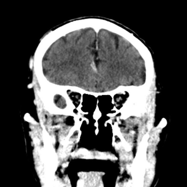 File:Brain metastases from lung cancer (Radiopaedia 27849-28092 Coronal C+ delayed 18).jpg