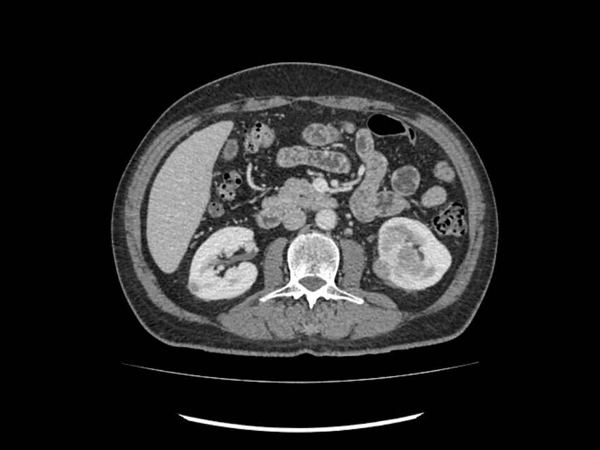 Brain metastases from renal cell carcinoma (Radiopaedia 42222-45328 B 109).jpg