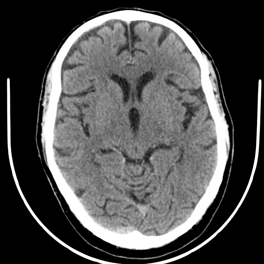 Brain metastasis (Radiopaedia 42617-45760 Axial non-contrast 20).jpg