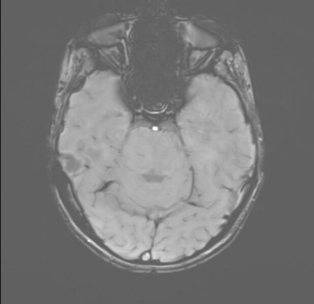File:Brainstem glioma (Radiopaedia 70548-80674 Axial SWI 18).jpg