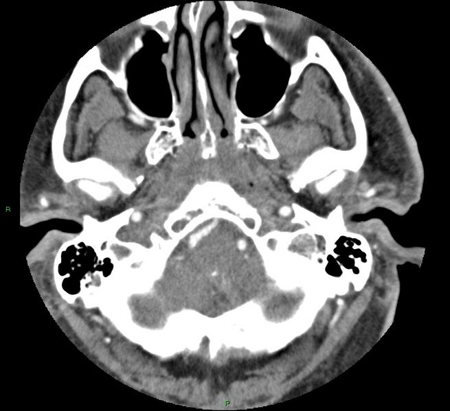 File:Brainstem hemorrhage (Radiopaedia 58794-66028 D 29).jpg
