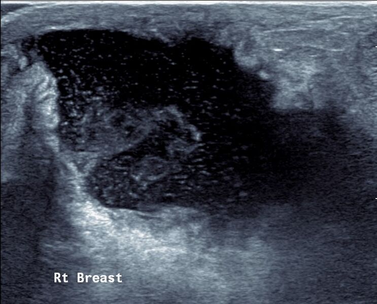 File:Breast abscess (Radiopaedia 55347-61769 A 1).jpg