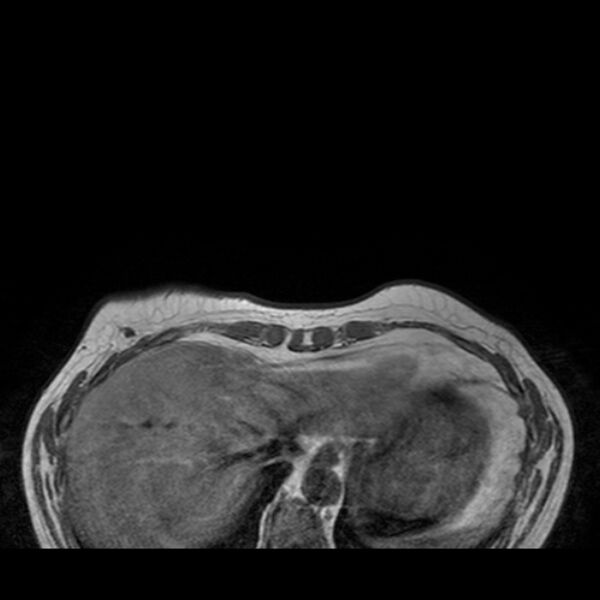 File:Breast implants - MRI (Radiopaedia 26864-27035 Axial T1 4).jpg