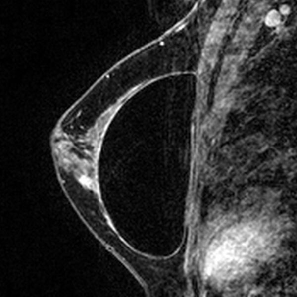 File:Breast implants - MRI (Radiopaedia 26864-27035 Sagittal T2 30).jpg