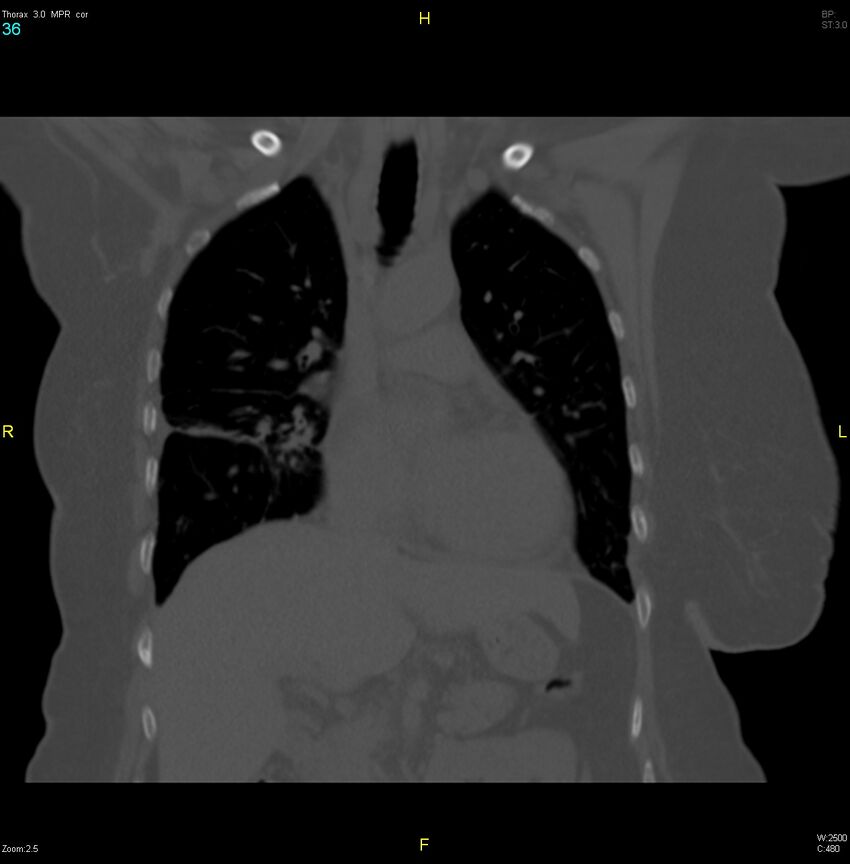 Breast primary with lung and bone metastases (Radiopaedia 40620-43228 bone window 36).jpg