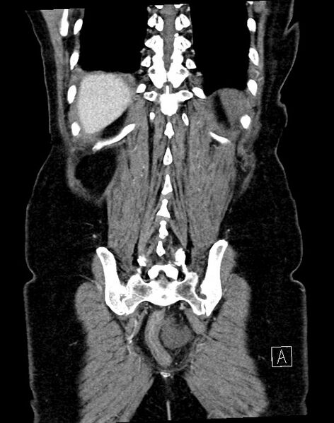 File:Broad ligament hernia (Radiopaedia 84802-100276 B 6).jpg