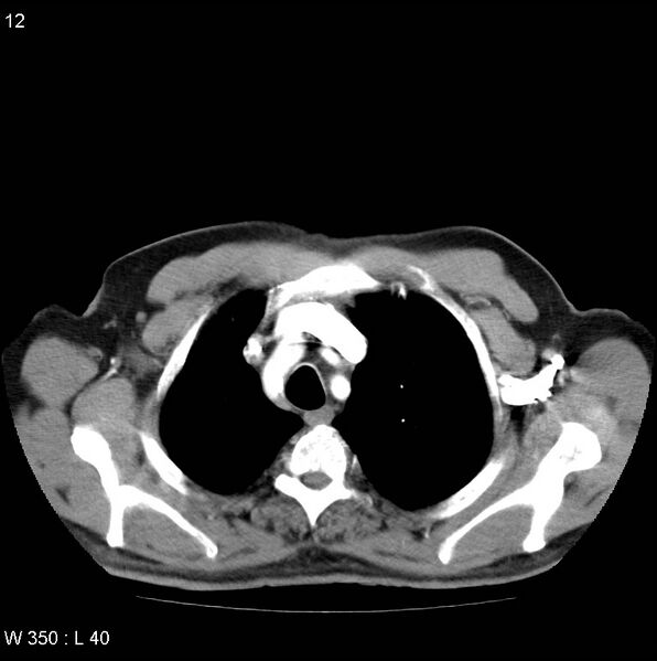 File:Bronchial carcinoid tumor with right lower lobe collapse (Radiopaedia 29060-29422 A 11).jpg