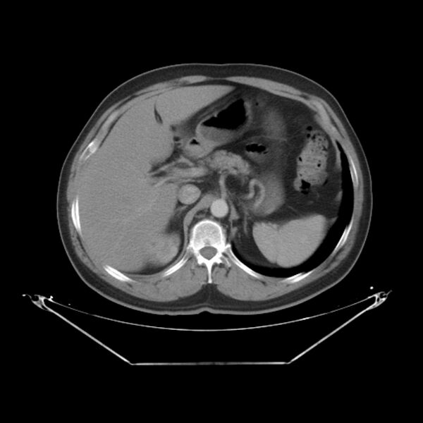 File:Bronchogenic carcinoma with upper lobe collapse (Radiopaedia 29297-29726 C 32).jpg
