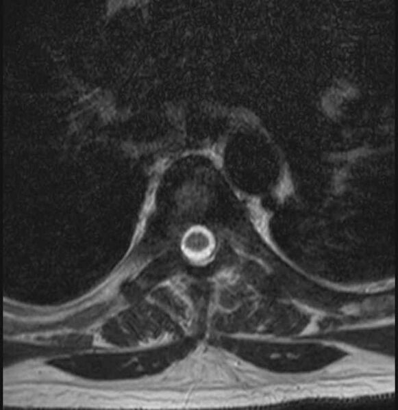 File:Brown tumors compressing the spinal cord (Radiopaedia 68442-78030 A 37).jpg
