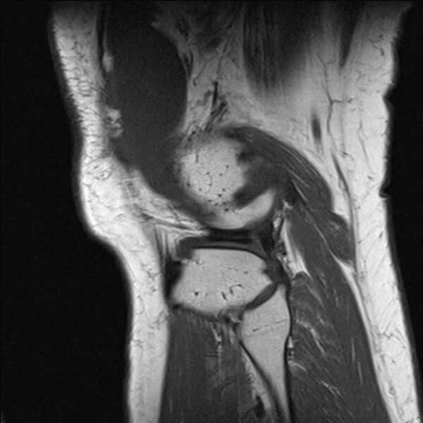 File:Bucket handle tear - medial meniscus (Radiopaedia 79028-91942 Sagittal T1 3).jpg