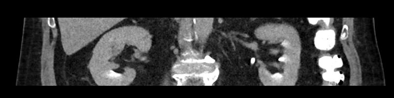 File:Buried bumper syndrome - gastrostomy tube (Radiopaedia 63843-72575 Coronal 26).jpg