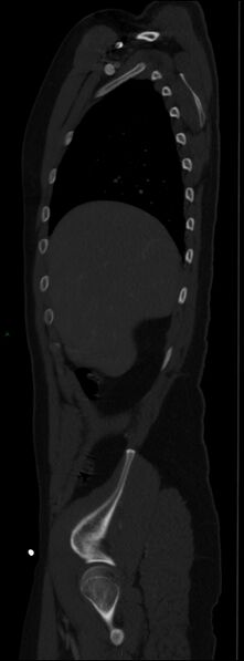 File:Burst fracture (Radiopaedia 83168-97542 Sagittal bone window 37).jpg