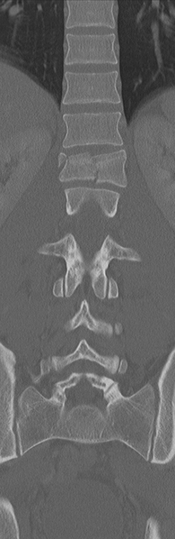 File:Burst fracture - T12 with conus compression (Radiopaedia 56825-63647 Coronal bone window 23).png