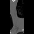 C5 facet fracture (Radiopaedia 58374-65499 Sagittal bone window 69).jpg