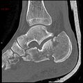 Calcaneal fracture and associated spinal injury (Radiopaedia 17896-17656 Sagittal bone window 2).jpg