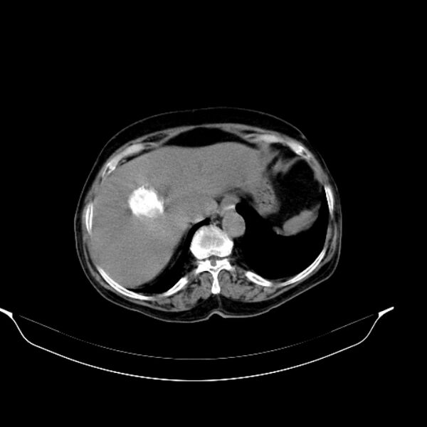 File:Calcified hydatid cyst (Radiopaedia 62000-70085 Axial non-contrast 26).jpg