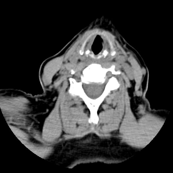 File:Calcified meningioma - cervical canal (Radiopaedia 70136-80171 B 23).jpg