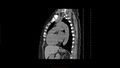 Calcified spleen (Radiopaedia 60952-68768 B 13).jpg