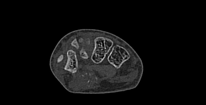 File:Calcifying aponeurotic fibroma (Radiopaedia 88423-105064 Axial bone window 103).jpg