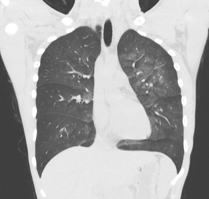 Cannabis-induced diffuse alveolar hemorrhage (Radiopaedia 89834-106946 Coronal lung window 54).jpg