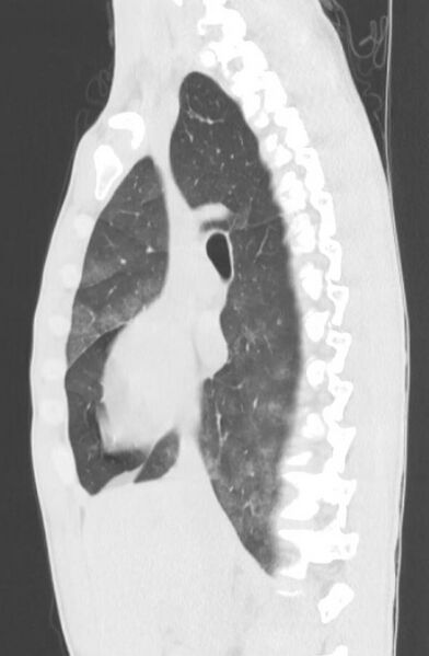 File:Cannabis-induced diffuse alveolar hemorrhage (Radiopaedia 89834-106946 Sagittal lung window 59).jpg