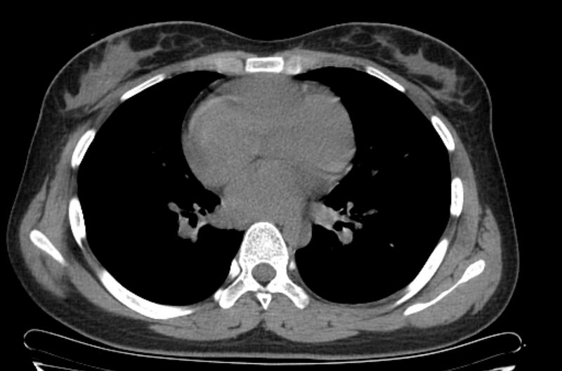 File:Cannonball metastases - uterine choriocarcinoma (Radiopaedia 70137-80173 Axial non-contrast 66).jpg
